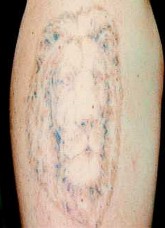 Odstraňování tetování laserem - po 3 ošetřeních