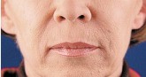 Výplňové injekce - po aplikaci Restylanu